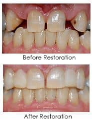 Before and After dental work using cosmetic bonding and veneering