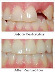 Dental implants before and after image