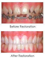 full mouth reconstruction, before and after pictures