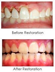wilmington dentist, periodontal laser surgery