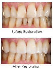 porcelain veneers, before and after photos
