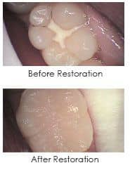 white dental restoration