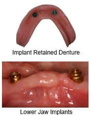 implant retained dentures