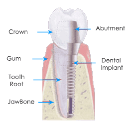 Dental implant and tooth illustration