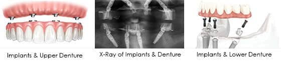 wilmington dentist implant retained denture