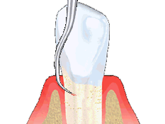 Wilmington Dentist - Dental scaling