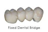 fixed dental bridgework