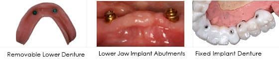 Wilmington dentist implant retained denture