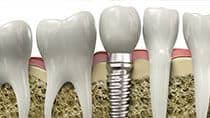Wilmington Dentist - Restoration Dentistry