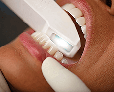 dental impression with scanner