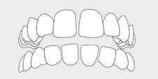 Invisalign correctable - spacing