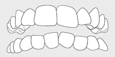 Invisalign correctable - overcrowing